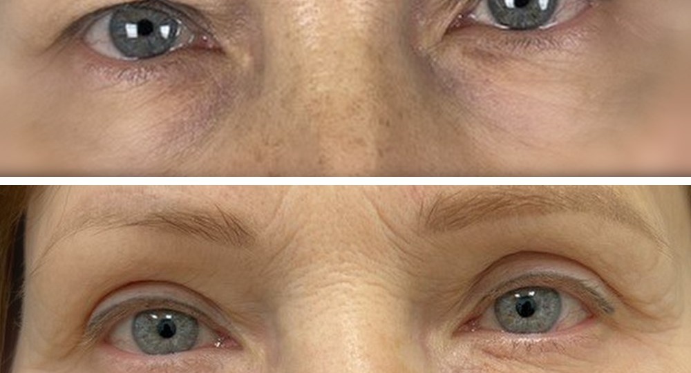 Верхняя блефаропластика с броулифтингом