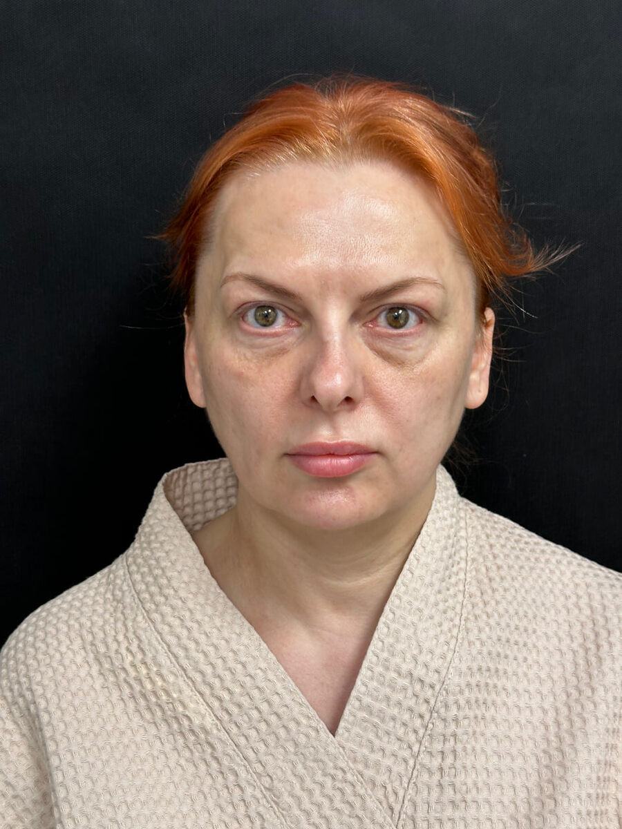 До операции