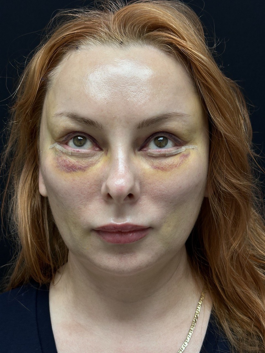 Ранний послеоперационный результат