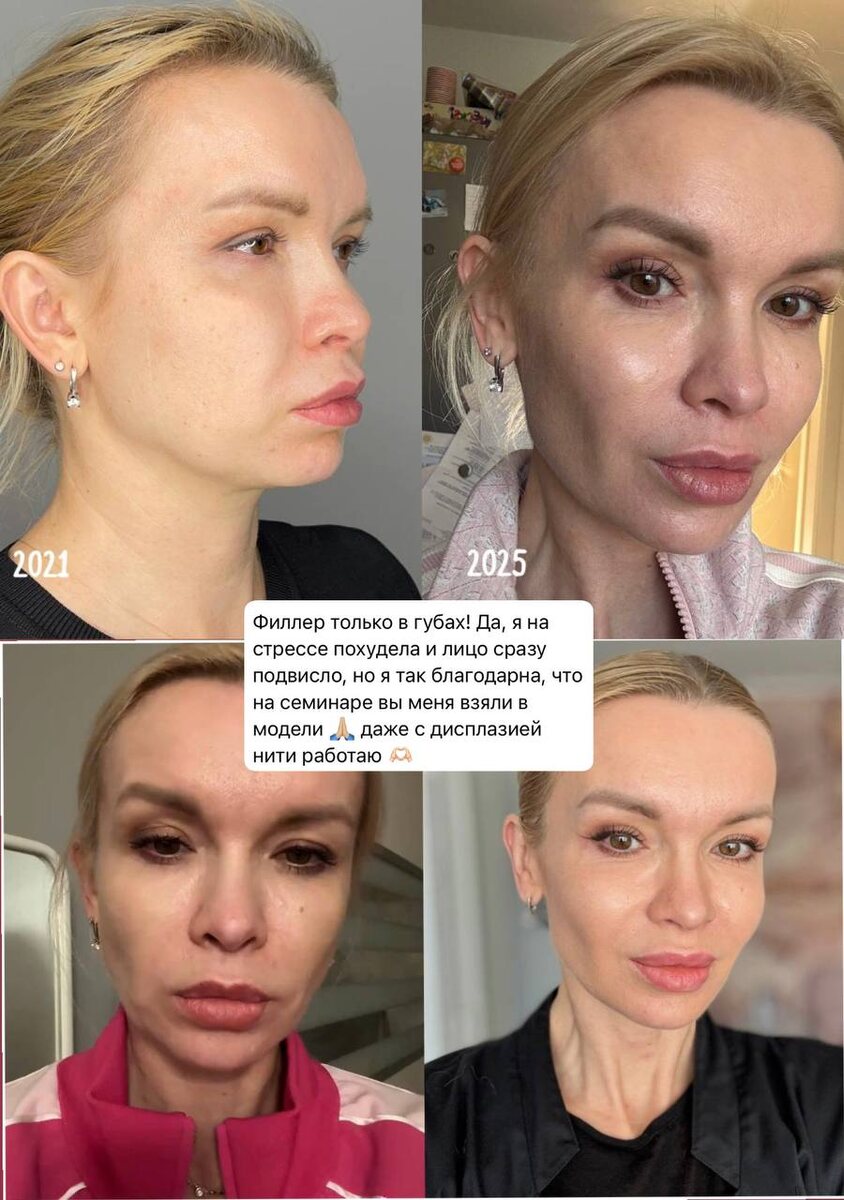 Фото пациентки, которая прошла коллагеностимуляцию PLLA-мононитями