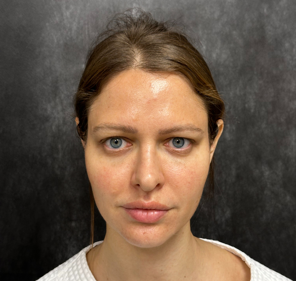 До операции