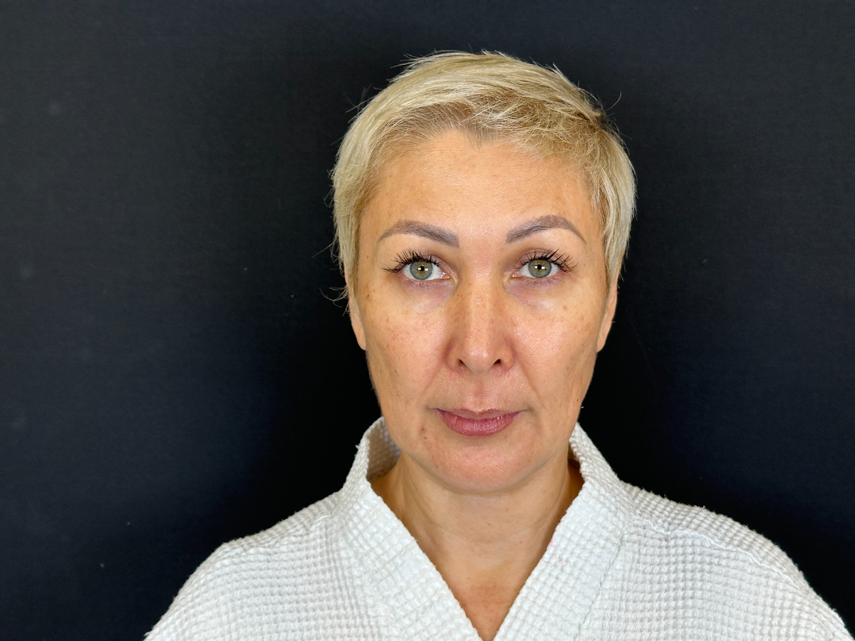 До операции