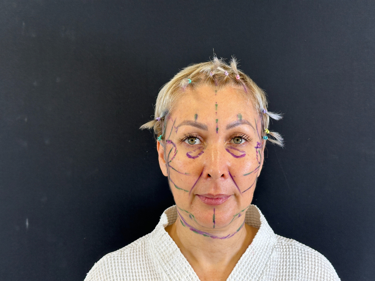 Разметка перед операцией