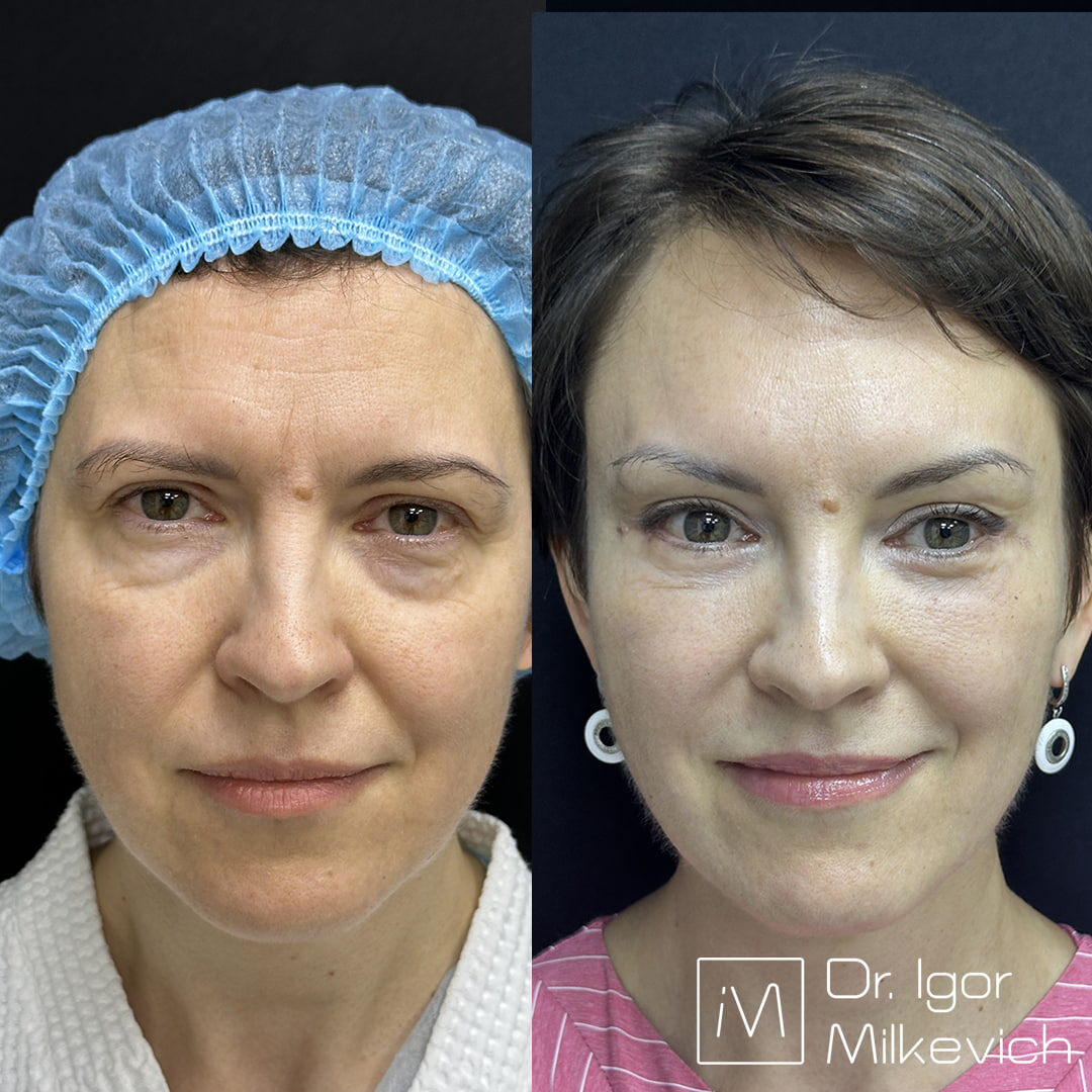 Месяц после операции