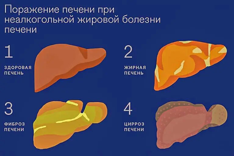 Жировая болезнь печени — как распознать и остановить, пока не стало поздно