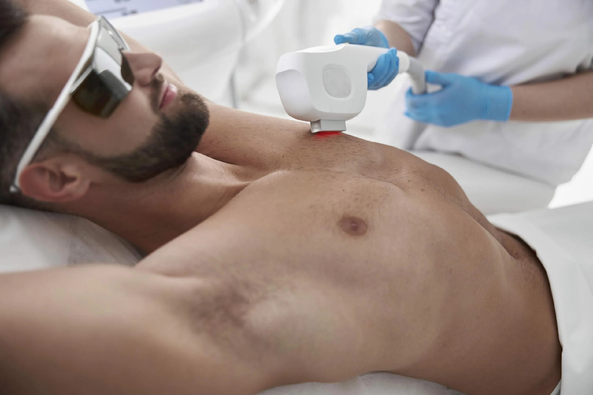 лазерная эпиляция