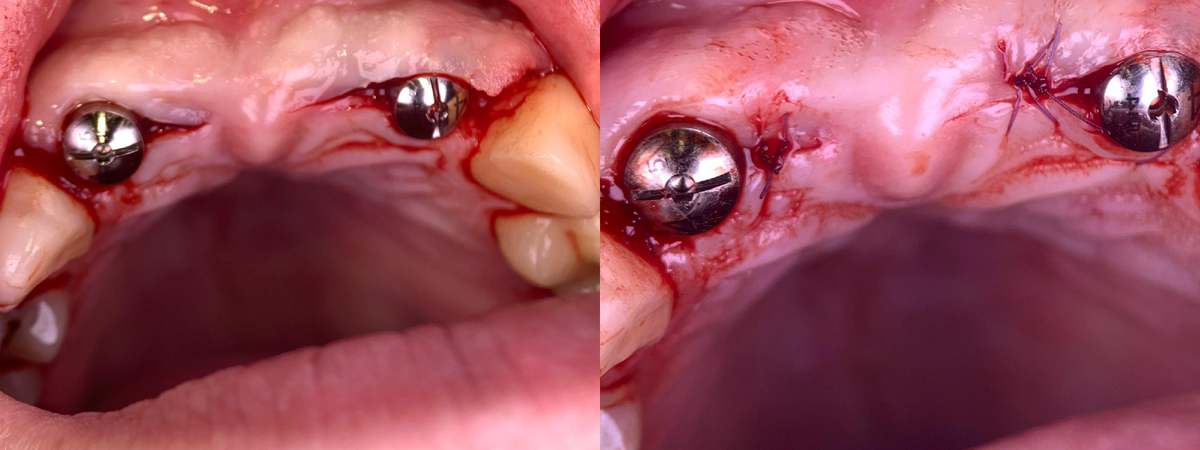 Этап установки имплантов