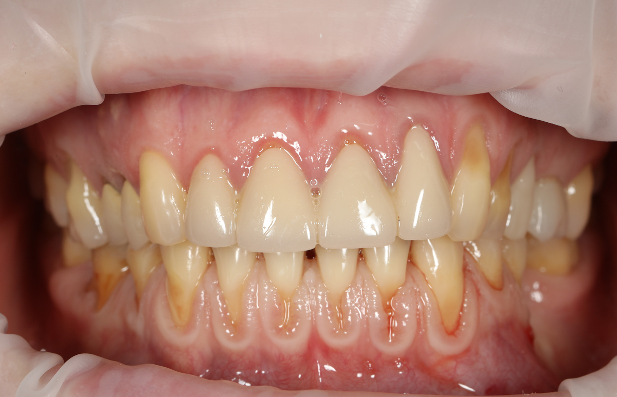 рецессия на нижней челюсти и на некоторых зубах верхней челюсти