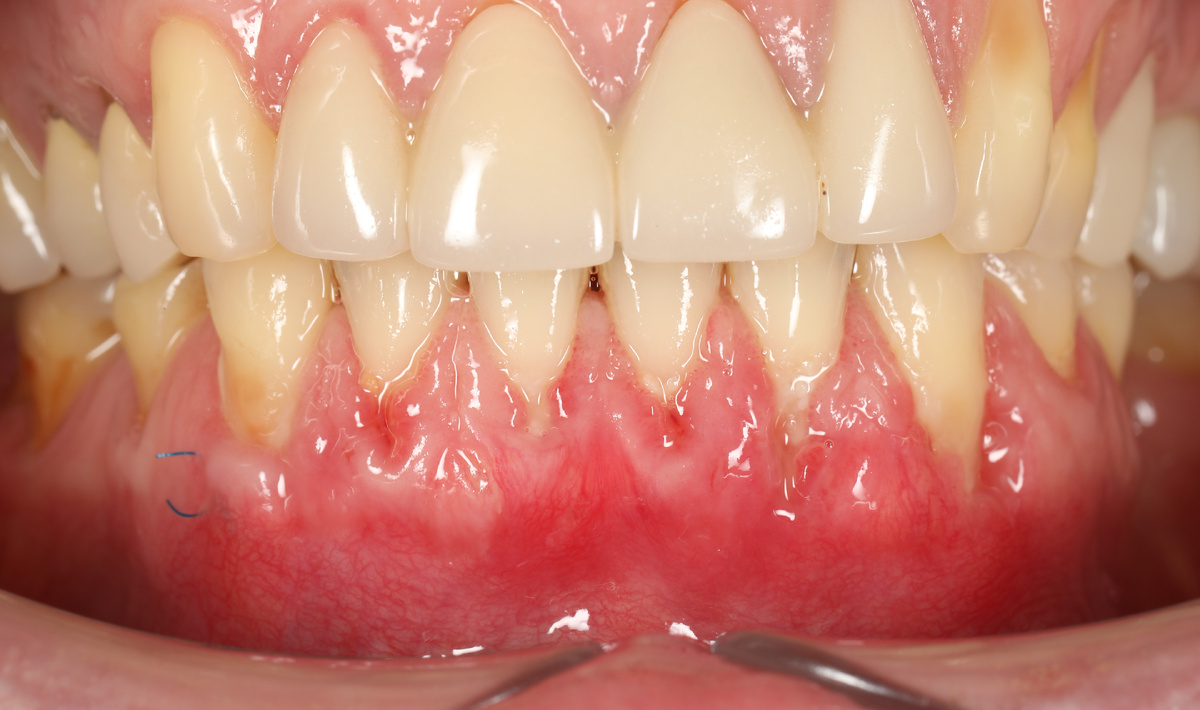 фото через 2 недели после операции. Полное заживление занимает месяц - два, за это время трансплантат успевает прижиться и сформировать новый уровень десны.