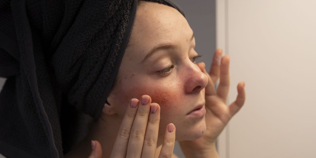 Атопическая кожа: наука знает, как помочь