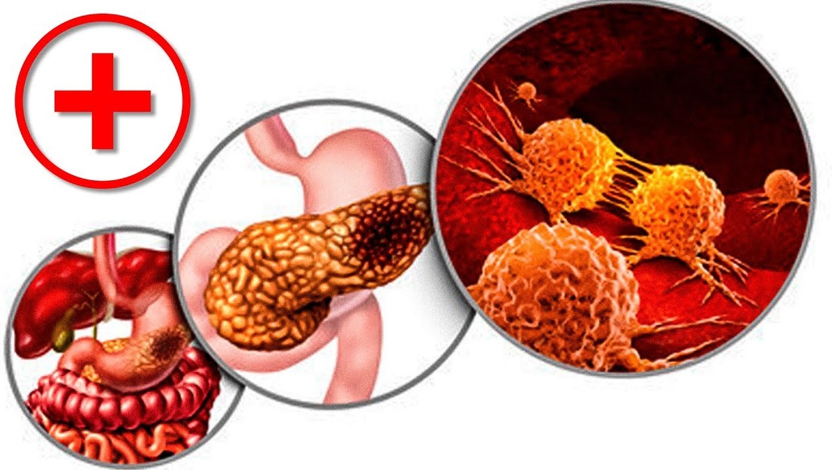 Начало рака поджелудочной: странные проявления, которые совпадают у всех пациентов