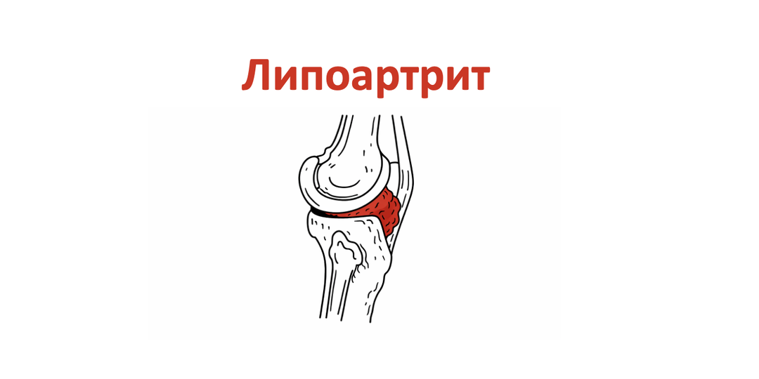 Липоартрит