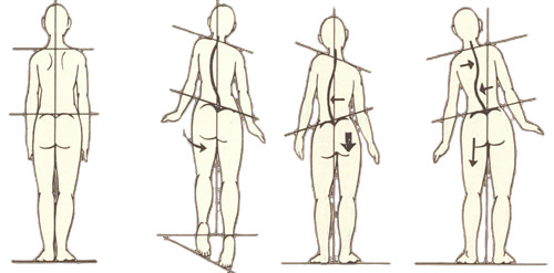 Максимальная польза: ортопедические стельки при перекосе таза