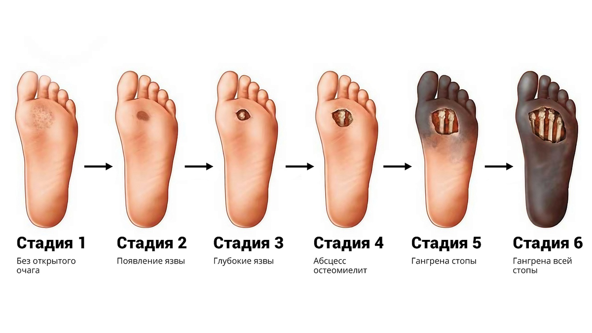 Диабетическая стопа. Источник: https://dzen.ru/a/aLgfwIQHz184VR4H

