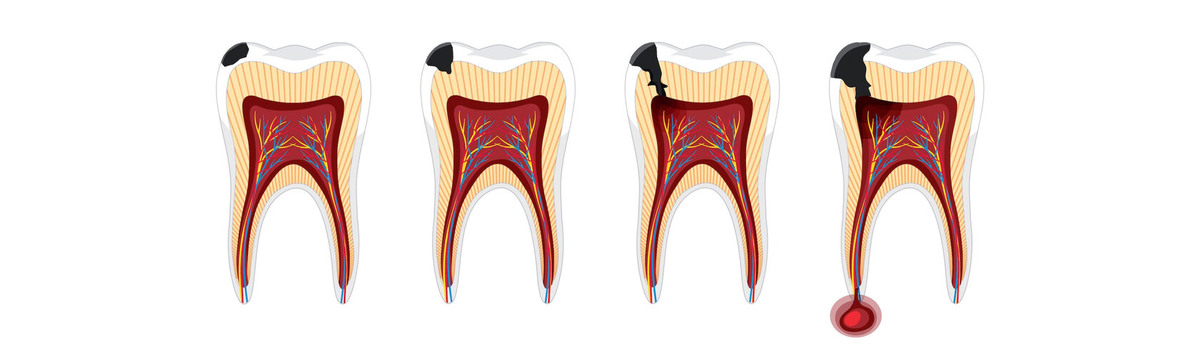 Пульпит и периодонтит: в чем разница 