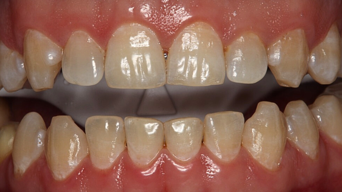 Улыбка нашего пациента до процедуры отбеливания. 