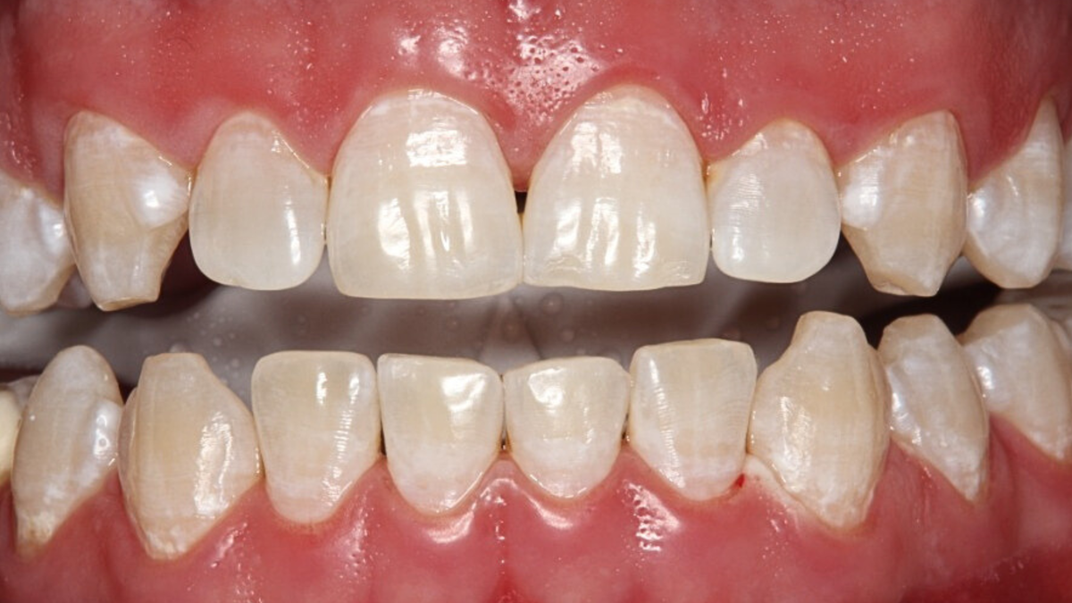 Улыбка нашего пациента после процедуры отбеливания. 