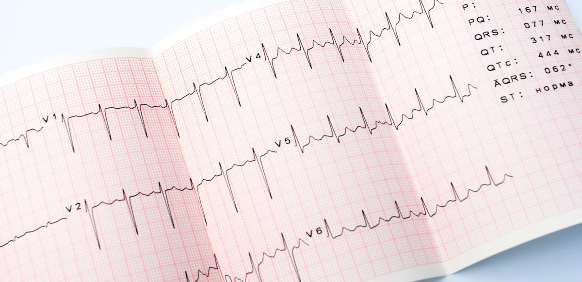 Такой график "рисует" аппарат ЭКГ. Источник: https://mfhc.ru/catalog/elektrokardiografy-defibrillyatory/