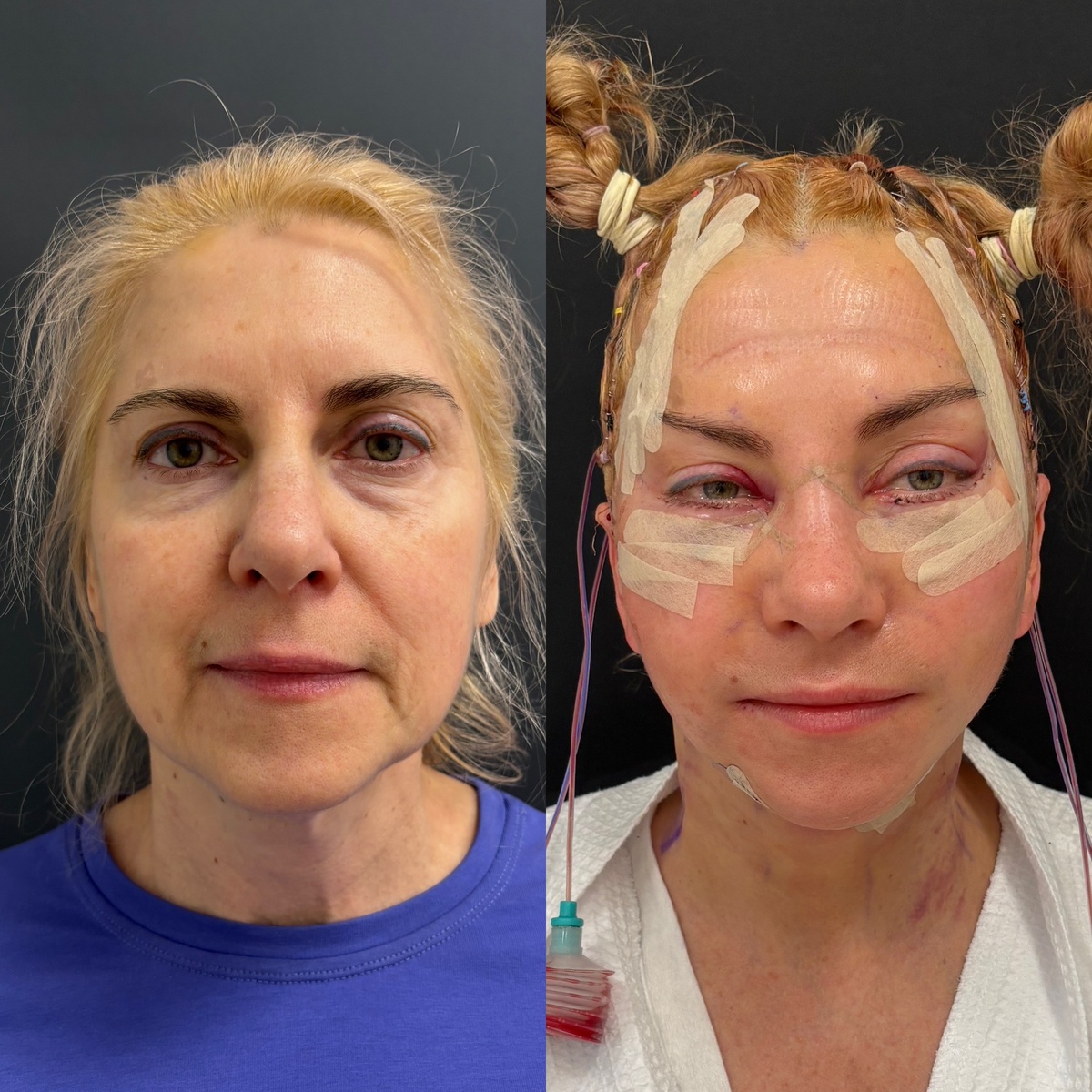 Первые сутки после комплексного омоложения лица (слева-до, справа-после операции). Хирург Остринская Т.В.