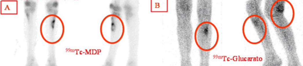 Горячие очаги на сцинтиграфии костей