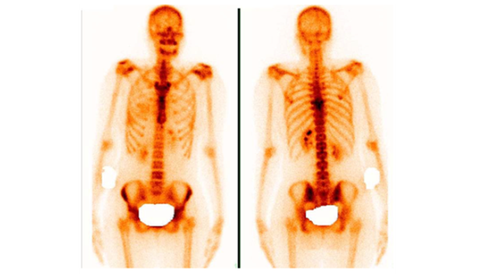 Сцинтиграфия костей при раке молочной железы: показания, лучевая нагрузка, порядок проведения процедуры