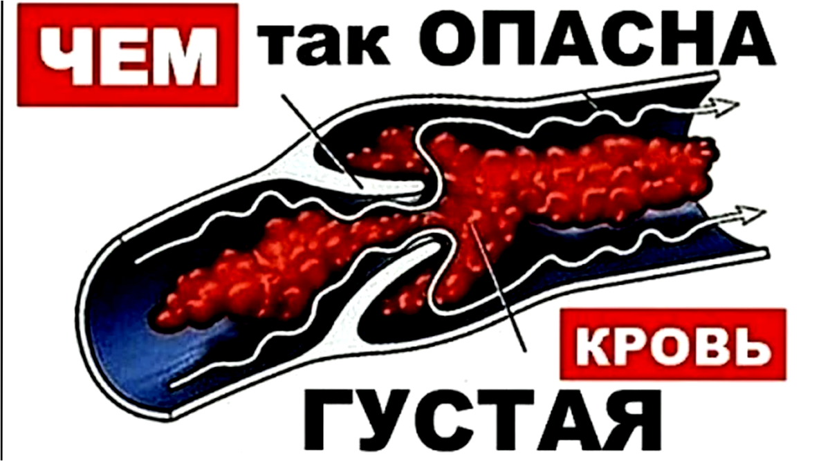 5 признаков, что кровь становится слишком густой для сосудов (чек-лист)