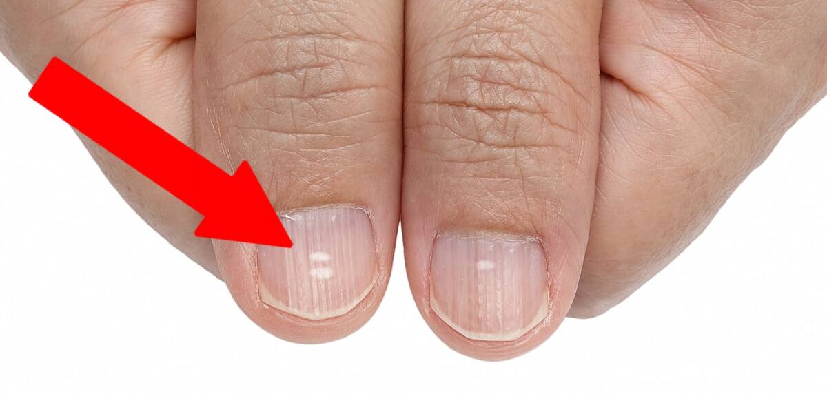 Белые пятна на ногтях — это не дефицит кальция: что говорят врачи
