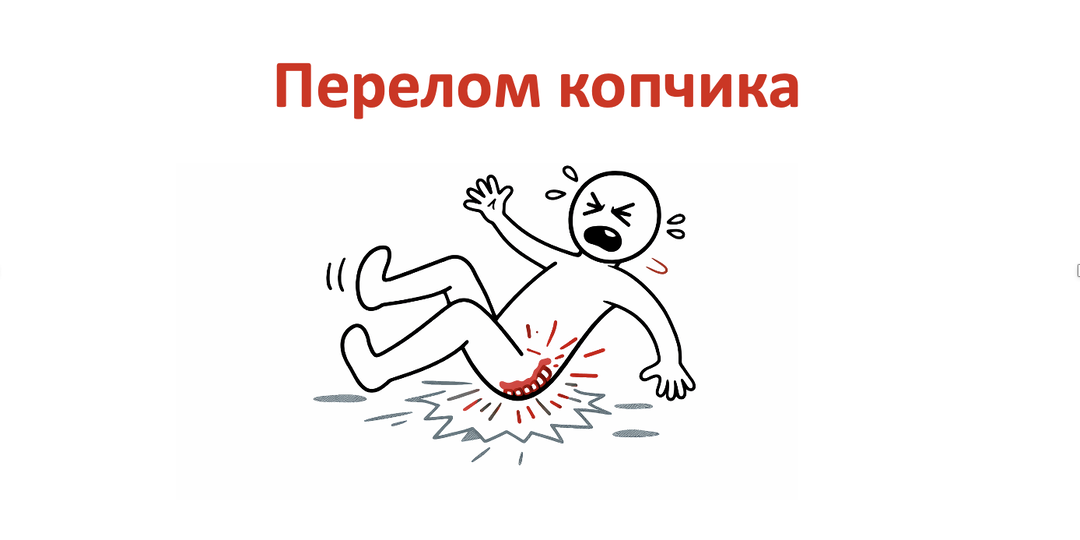 Перелом копчика