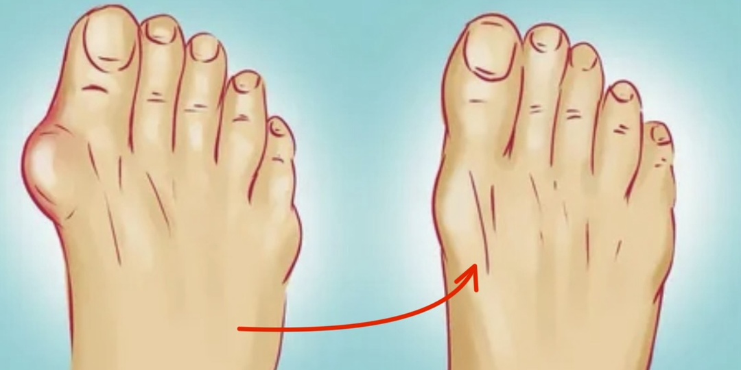 «Прощай» косточка на больших пальцах стоп: 8 важных правил, которые всегда со мной