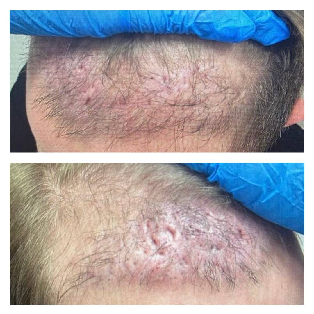 неудачная пересадка волос, которую пациент сделал в Московской клинике и пришел исправлять 