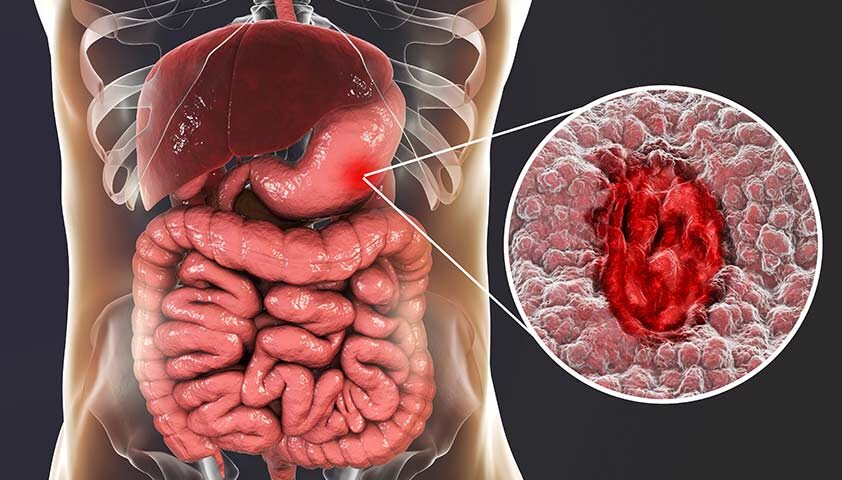 Гастрит - не болит. Тихий саботажник желудка: как его выявить и навсегда вылечить по последним стандартам