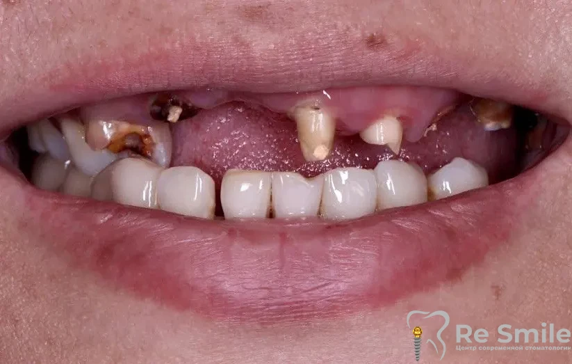 Пациентка обратилась с жалобами на расфиксацию и выпадение ортопедической конструкции на верхней челюсти, а также разрушенность и подвижность зубов на нижней челюсти.