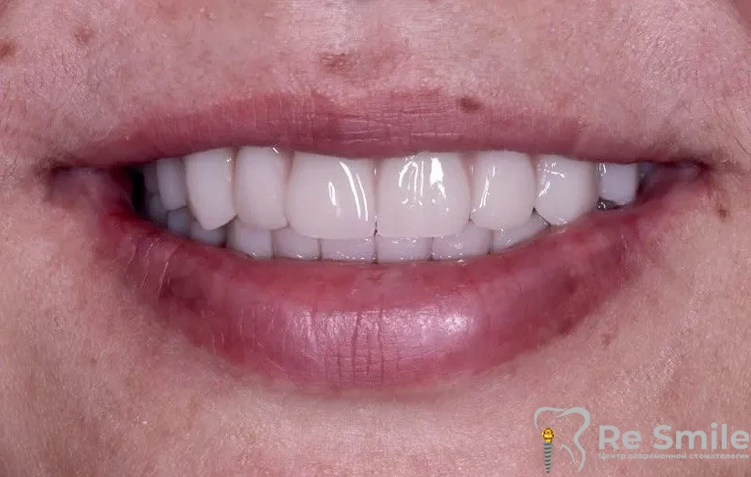 Было произведено удаление несостоятельных зубов и корней с одномоментной имплантацией по системе All-on-6 и немедленной нагрузкой временными адаптационными протезами.