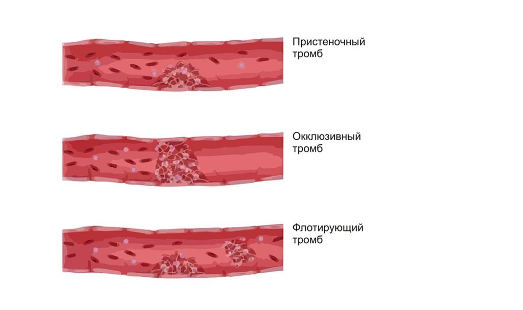 Тромбофлебит и риск тромбоэмболии