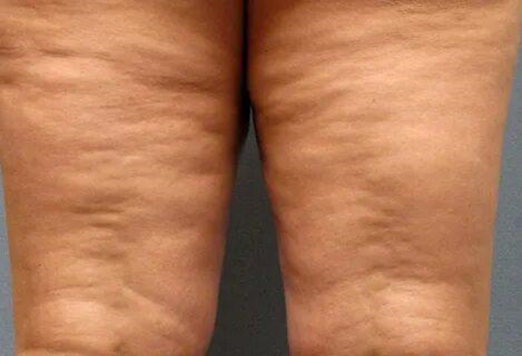 Целлюлит. Причины появления. Способы борьбы.