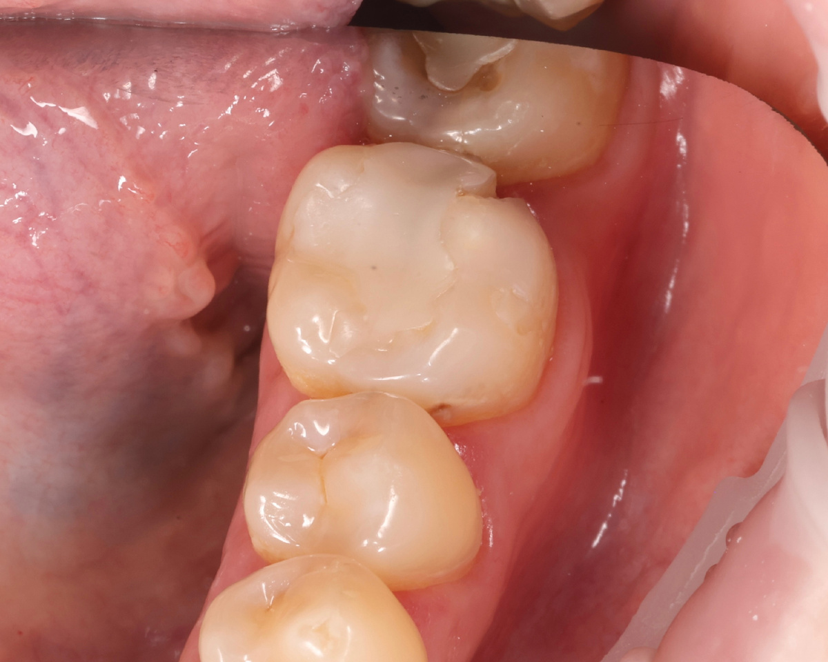 Зубы: 3.5.,3.6,3.7. На первый взгляд в помощи нуждается только 3.6 зуб, но давайте я продолжу рассказ