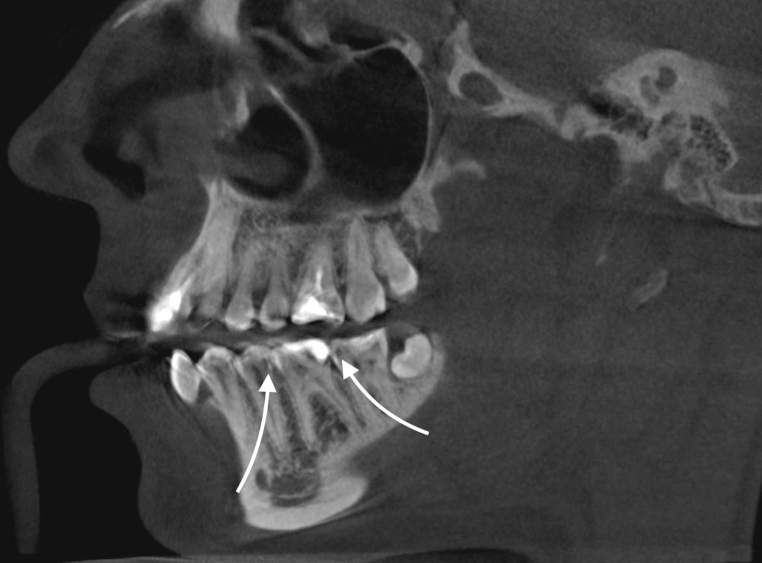 Стрелками указан "контаткный кариес" на зубах 3.5, 3.7
