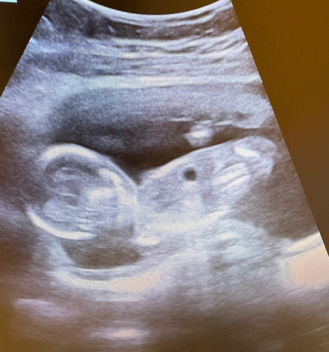 Беременность 18 недель. Фото из архива автора.