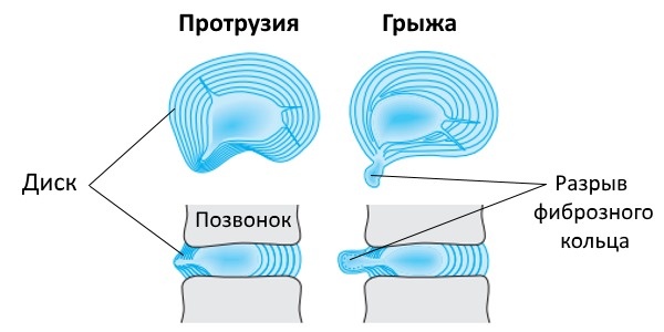 Протрузия или грыжа: простое объяснение разницы за 2 минуты