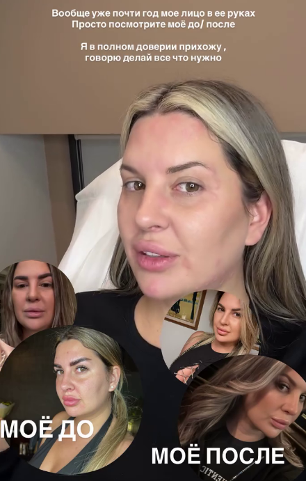 Бывшая участница телепроекта Дом 2 Майя Донцова призналась своим 
подписчикам, что она устала ходить с лицом, как воздушный шарик, поэтому
 воспользовалась моментом, нашла свободное время и отправилась к своему 
косметологу.



Донцова поставила ботокс не только в лоб, но и в другие части лица, 
чтобы кожа не обвисала и не морщинилась, результат превзошел все 
ожидания, поэтому Майя сразу же сделала несколько рекламных видео для 
подписчиц.



Донцовой нужно часто ходить на мероприятия в сопровождении жениха Дана 
Подлецкого, который работает в сфере продвижения контента, о чем мы 
рассказывали на шлоке. Поэтому Майя часто прибегает к уколам красоты и 
витаминам, чтобы перед важными встречами быстро привести себя в форму.



Зрители Дома 2 считают, что Донцова напрасно так часто корректирует 
внешность с помощью уколов красоты и её кожа уже не такая упругая, какой
 могла оставаться долгое время. Стоит ли в 33 года так злоупотреблять 
услугами косметолога, как считаете?