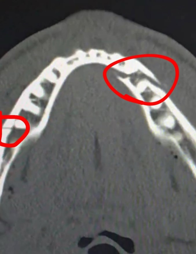 снимок челюсти Джейка Пола после боя с Энтони Джошуа