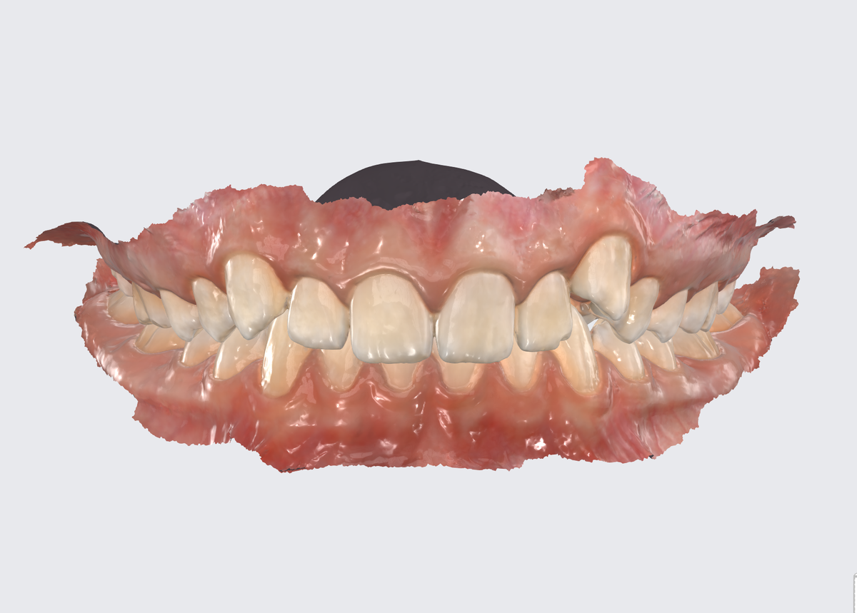 Цифровой слепок челюстей перед ортодонтическим вмешательством