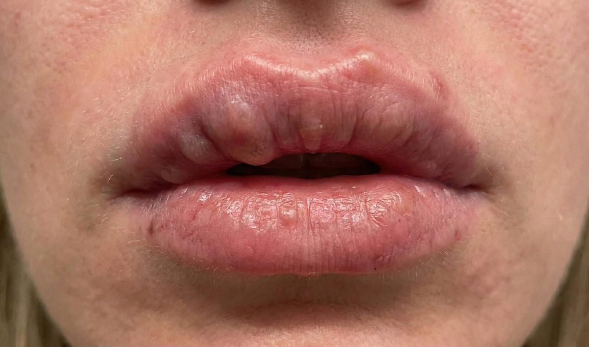 плотные узлы и тяжи после введения биополимера