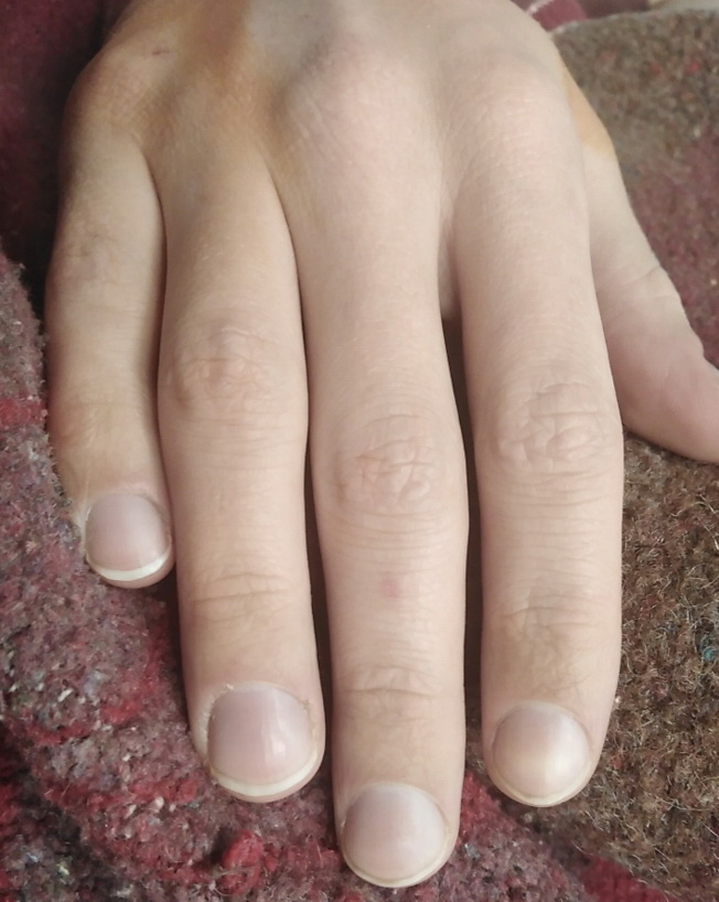 Так меняются дистальные фаланги пальцев при хронической гипоксии