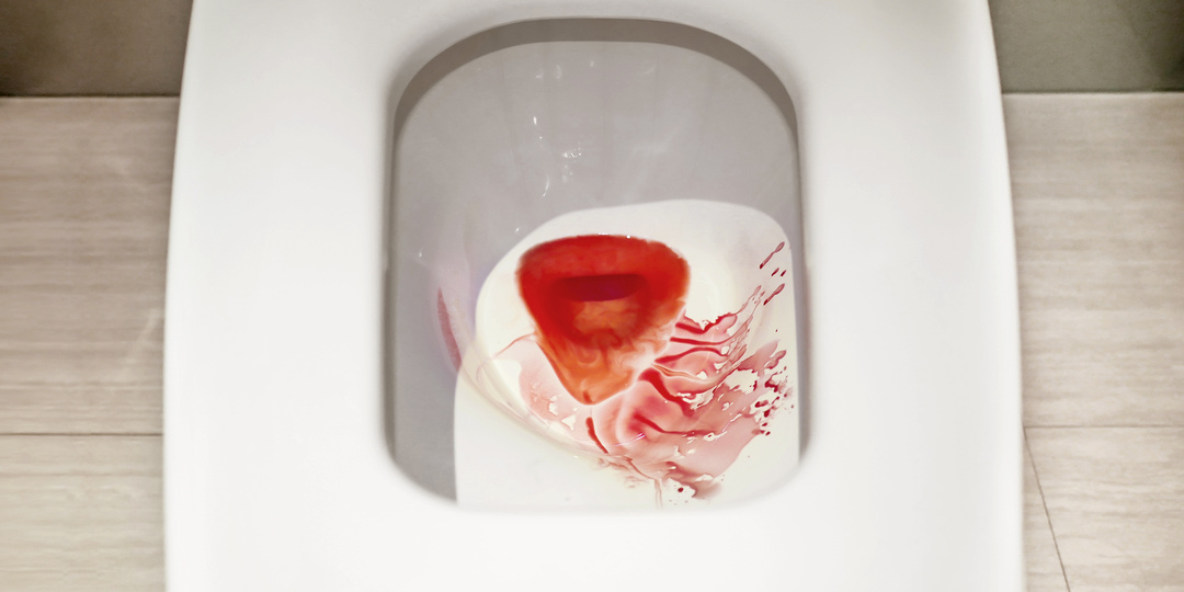 Как лечить кровоточащий геморрой?