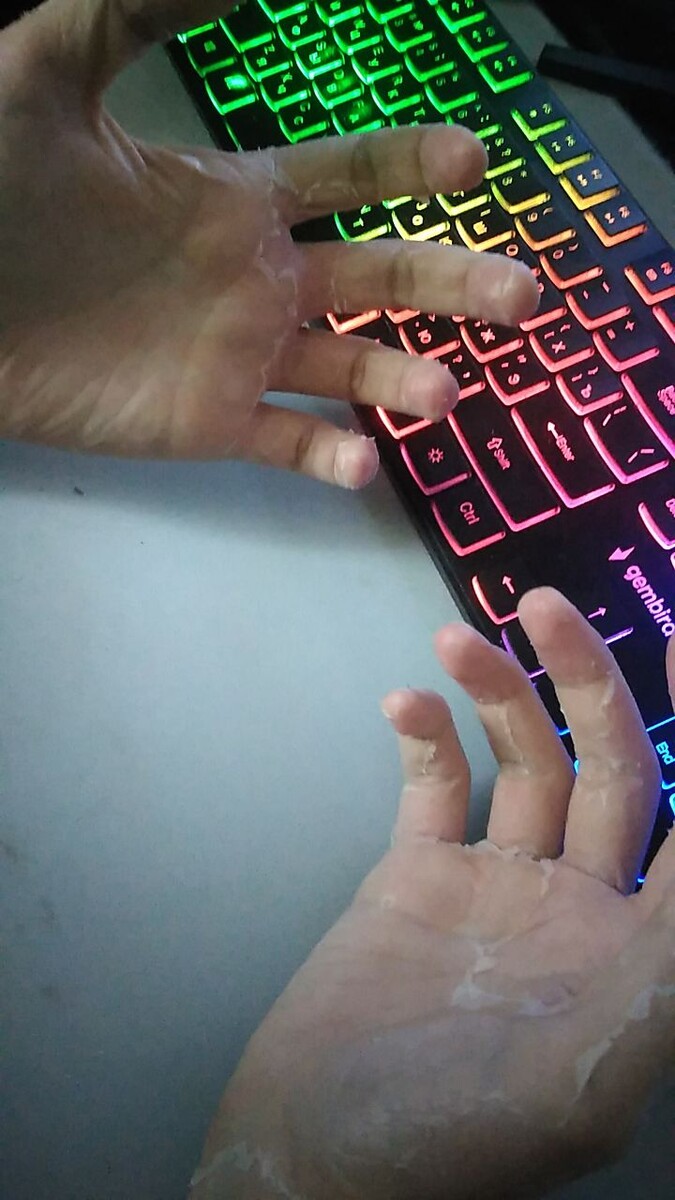 На фото "последняя" фаза когда дерматит перешел на ладони, личное фото автора