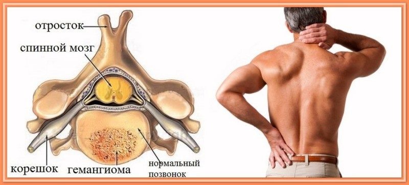 «Это не опухоль в обычном смысле»: что на самом деле означает диагноз «гемангиома позвоночника» — и стоит ли бояться?