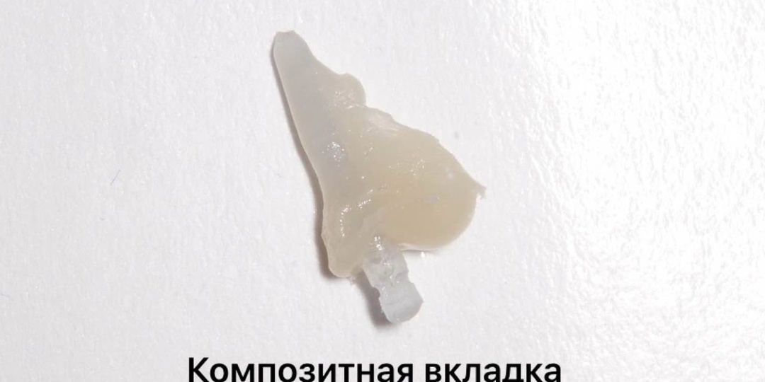 От зуба остался корень - спасаем правильно. Перелечивание канала, восстановление стенок, build-up со стекловолокном