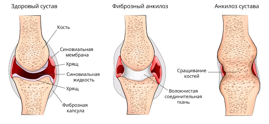 «Соль в суставах»: правда и мифы о том, почему тело «скрипит», и как вернуть себе лёгкость движений