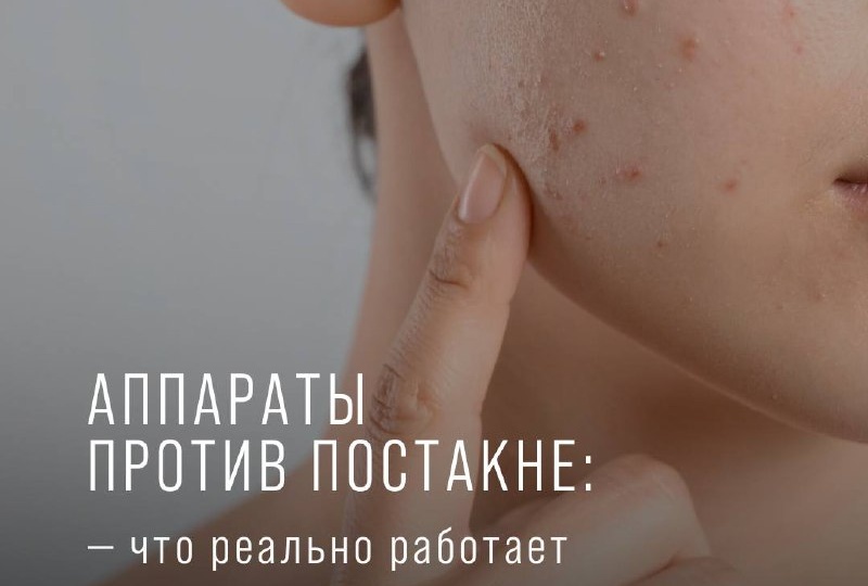 Постакне — не только эстетическая проблема, но и показатель того, что кожа нуждается в глубокой перестройке